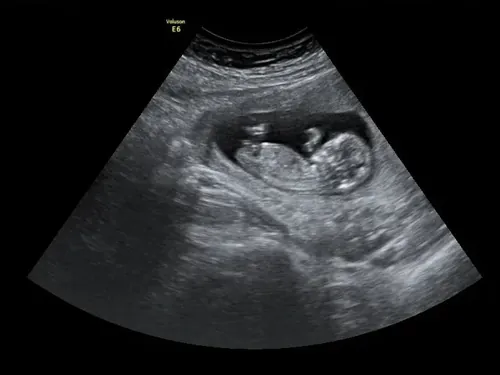 Imagen real de ultrasonido de recuerdo en Preggoland Mamas