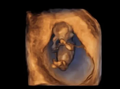 Imagen real de ultrasonido de recuerdo en Preggoland Mamas