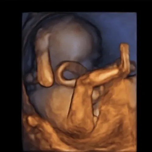 Imagen real de ultrasonido de recuerdo en Preggoland Mamas