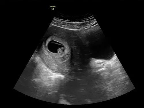 Imagen real de ultrasonido de recuerdo en Preggoland Mamas