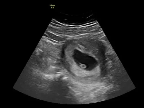 Imagen real de ultrasonido de recuerdo en Preggoland Mamas