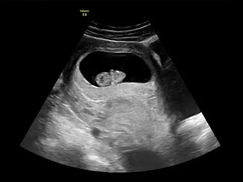Imagen real de ultrasonido de recuerdo en Preggoland Mamas